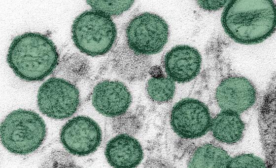 hantavirus-outbreak:-another-passenger-contracts-disease